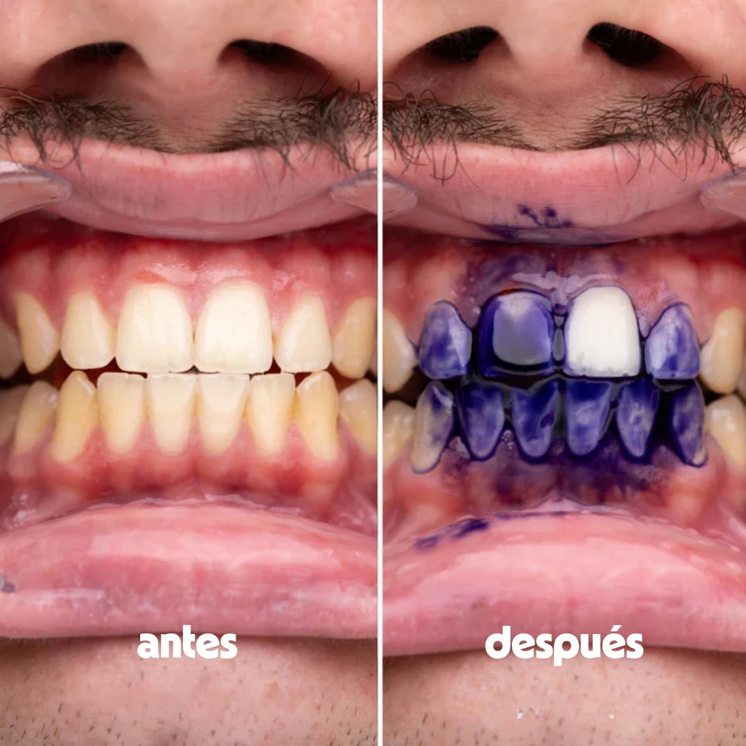Hismile® - Solución Blanqueadora Certificada - Sonrisa Perfecta en Casa