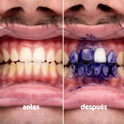 Hismile® - Solución Blanqueadora Certificada - Sonrisa Perfecta en Casa